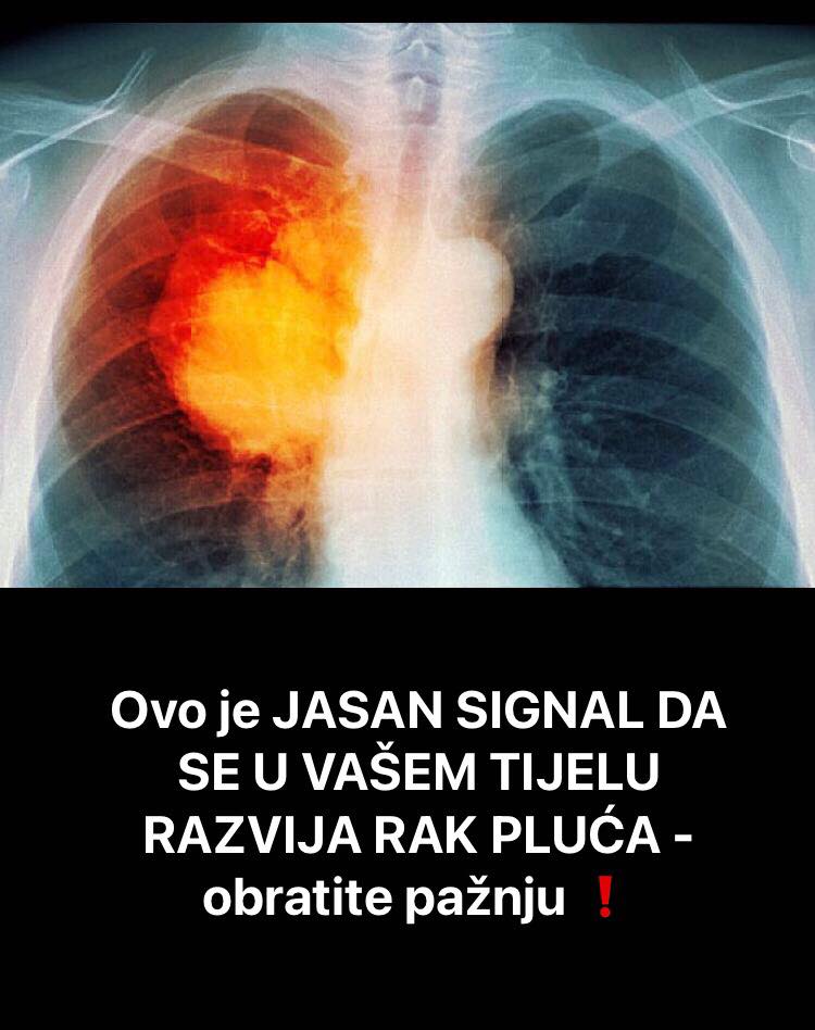 Pogledajte prvi simptom raka pluća, nije to kašalj