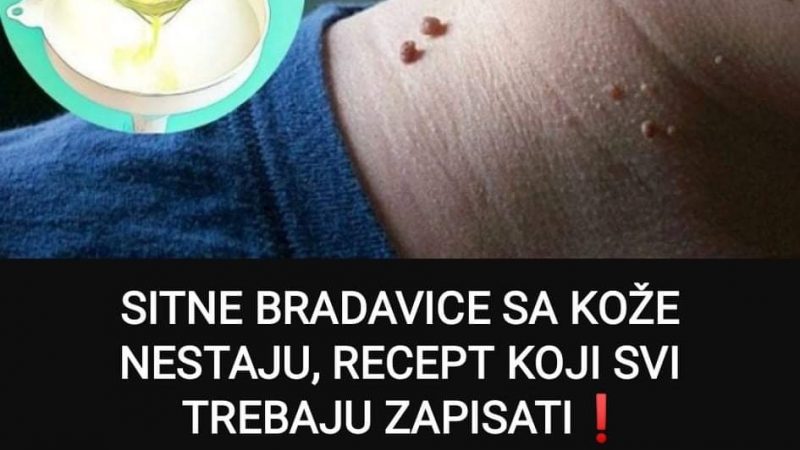 Pogledajte recept od kojeg sitne bradavice na koži brzo nestaju