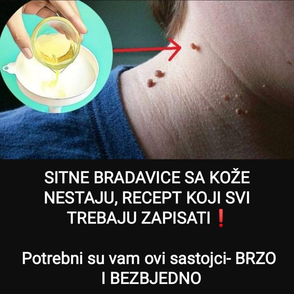 Pogledajte recept od kojeg sitne bradavice na koži brzo nestaju