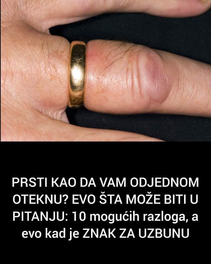 Pogledajte zašto Vam prsti odjednom nateknu