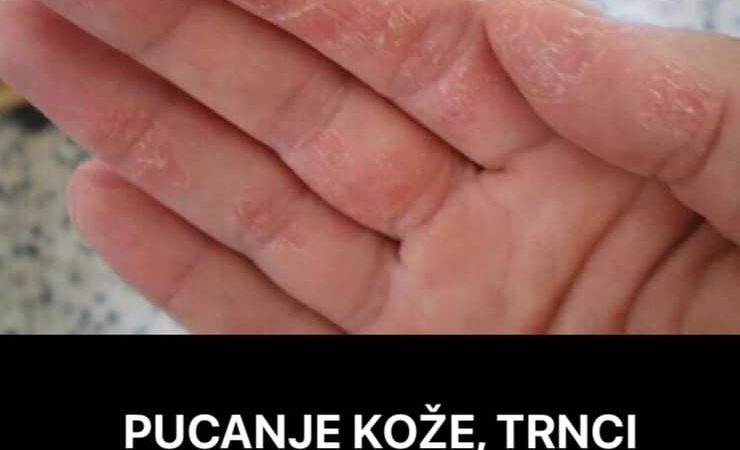 Trnci u tijelu, pucanje kože i sipadanje kose su prvi znakovi da sa vašim tijelom nešto nije u redu