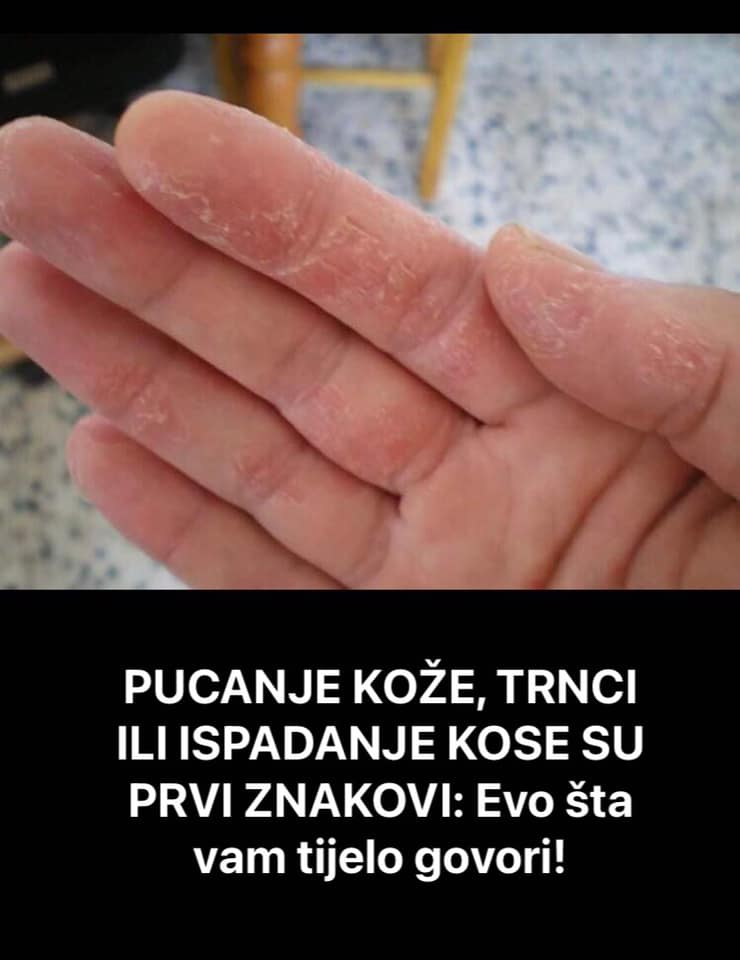 Trnci u tijelu, pucanje kože i sipadanje kose su prvi znakovi da sa vašim tijelom nešto nije u redu