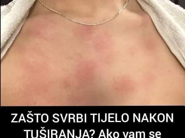 Pogledajte zbog čega vas svrbi tijelo nakon tuširanja