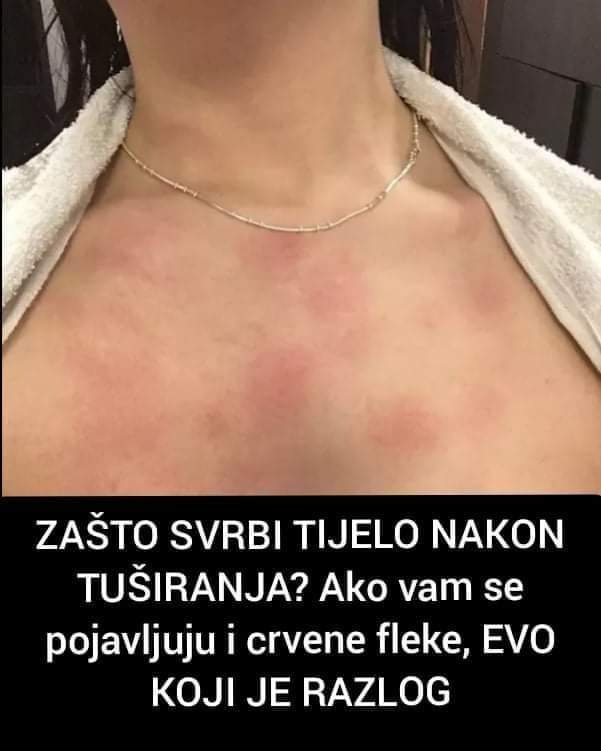 Pogledajte zbog čega vas svrbi tijelo nakon tuširanja