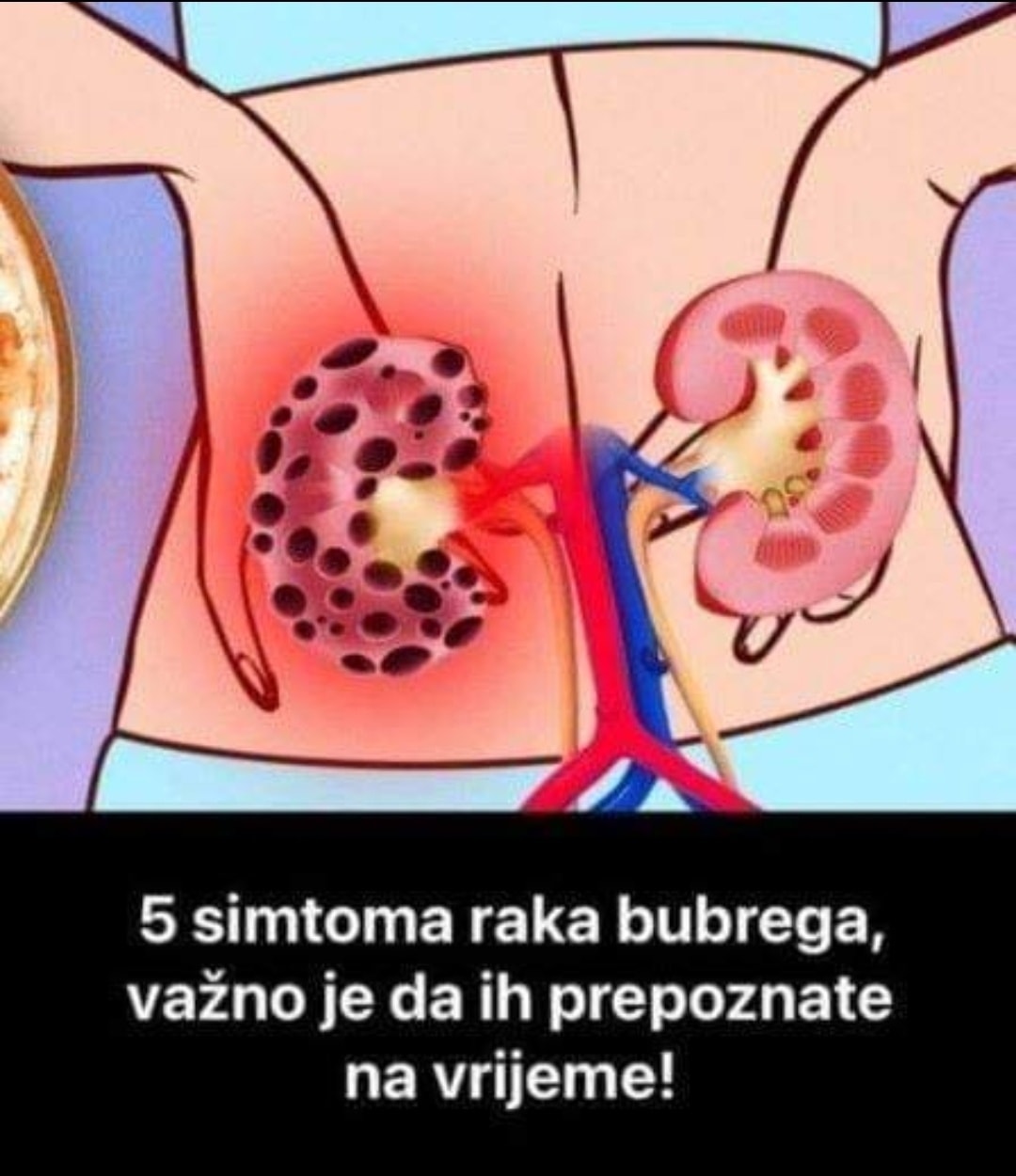 Pogledajte koji to simptomi ukazuju da imate rak bubrega