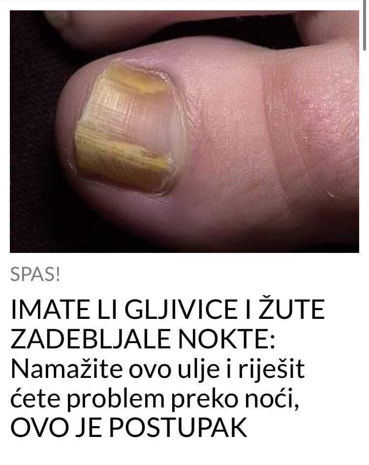 Pogledajte kako da se riješite gljivica na nogama