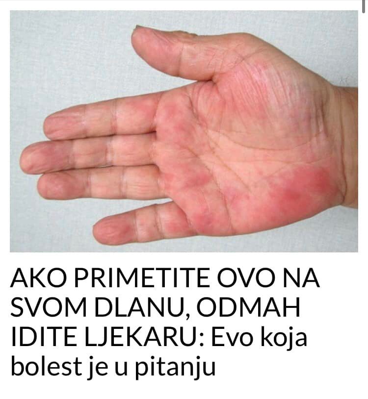 POGLEDAJTE KOJA JE BOLEST U PITANJU KADA IMATE OVO NA VAŠEM DLANU