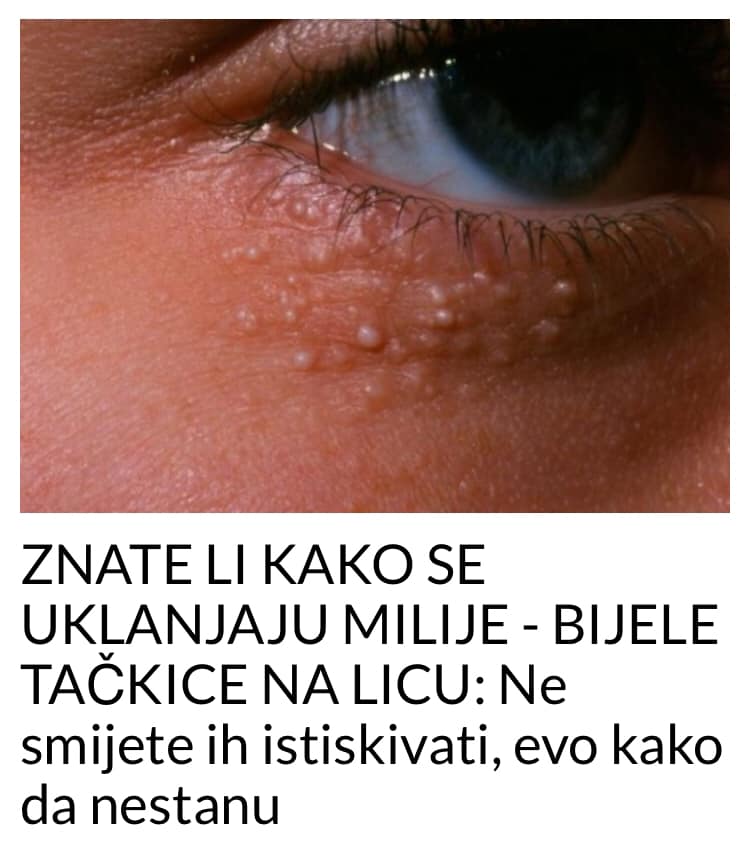 POGLEDAJTE KAKO DA UKLONITE BIJELE TACKICE SA LICA