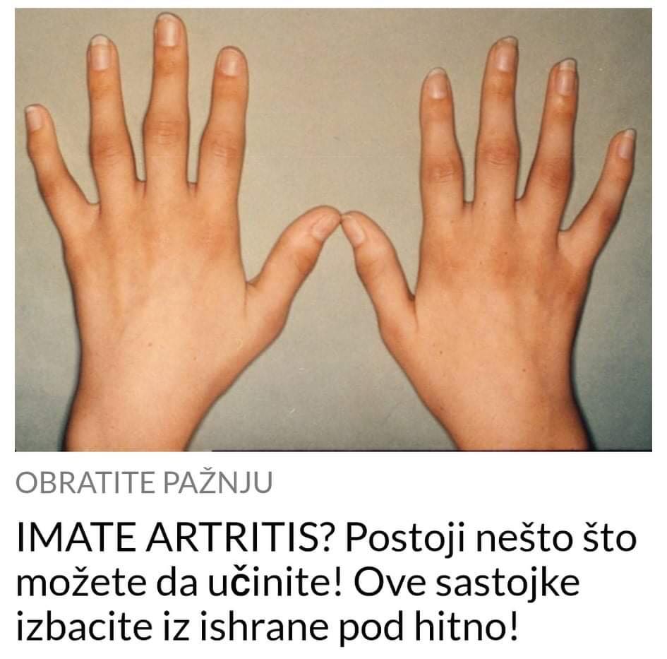 POGLEDAJTE ŠTA NE BI SMJELI JESTI KADA IMATE PROBLEMA SA ARTRITISOM