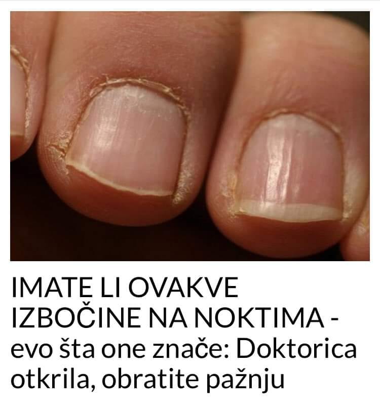 EVO STA ZNACE OVE IZBOCINE NA NOKTIMA