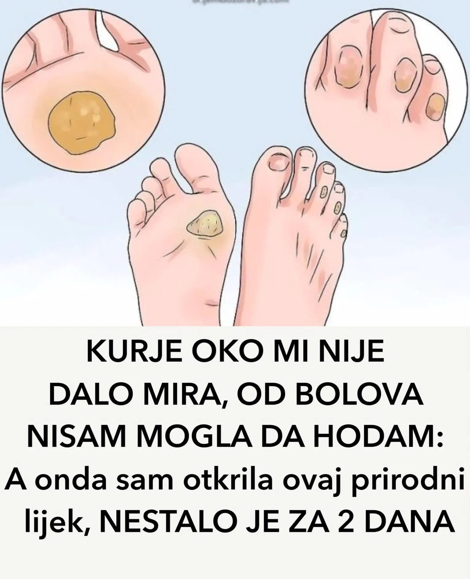 PRIRODAN LIJEK ZA KURJE OKO