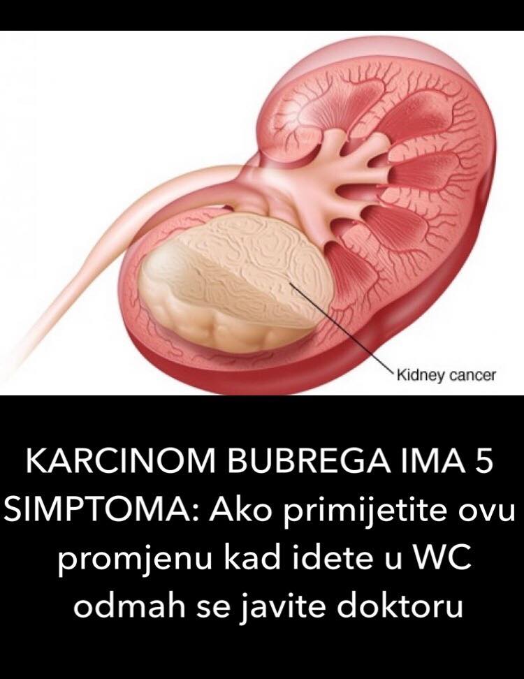 5 SIMPTOMA KOJI UKAZUJU DA IMATE KARCINOM BUBREGA