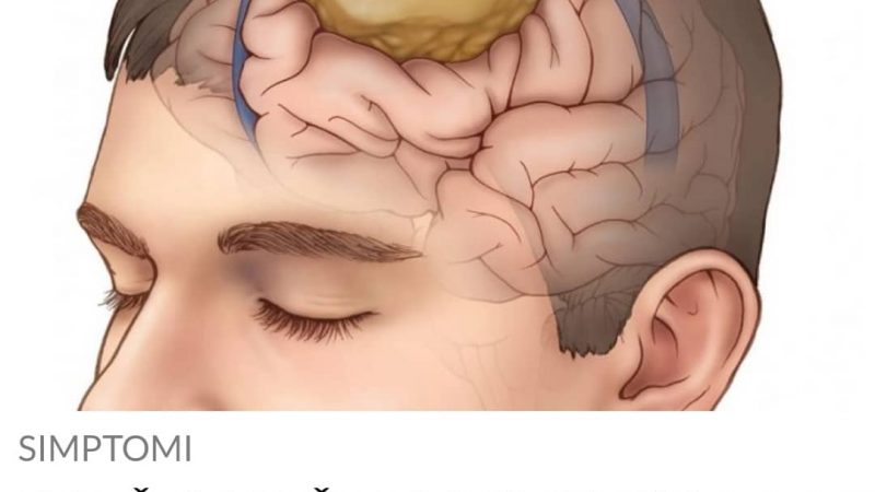 POGLEDAJTE KOJI SU SIMPTOMI TUMORA NA MOZGU