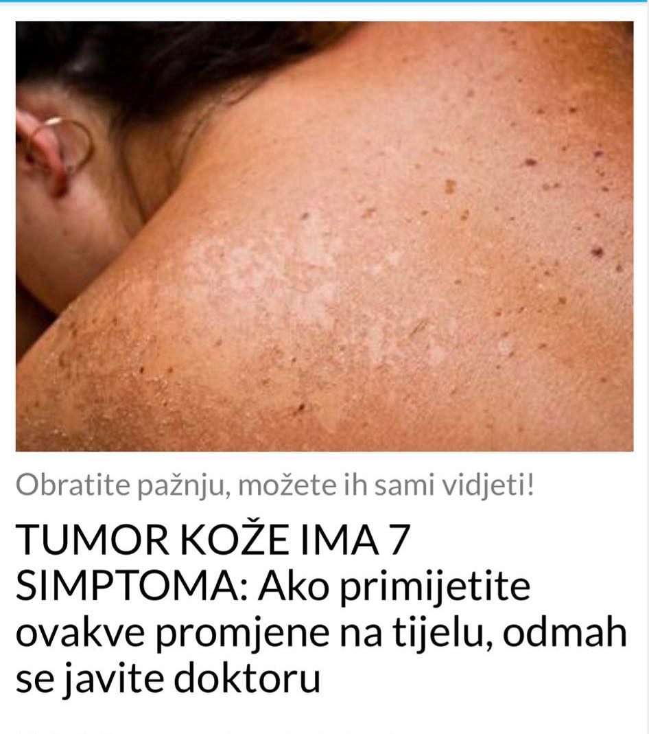 7 SIPTOMA KOD TUMORA KOZE